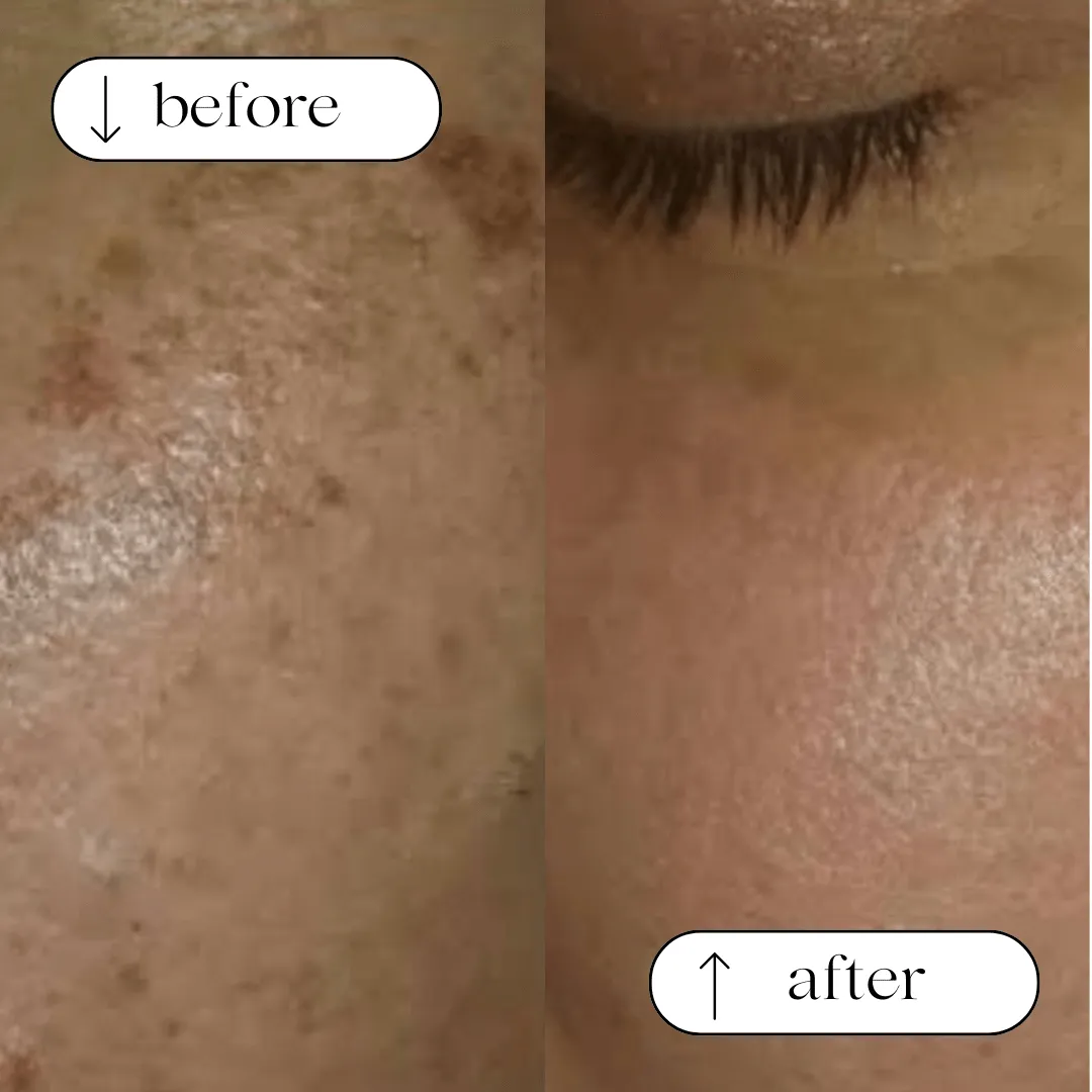 Pigmentation transformation before and after