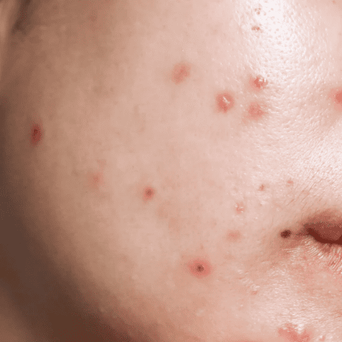 Breakouts and congestion